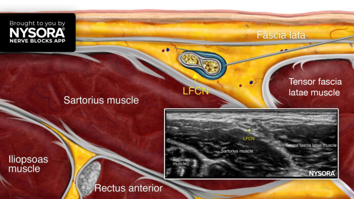 Tips for a Lateral Femoral Cutaneous Nerve Block