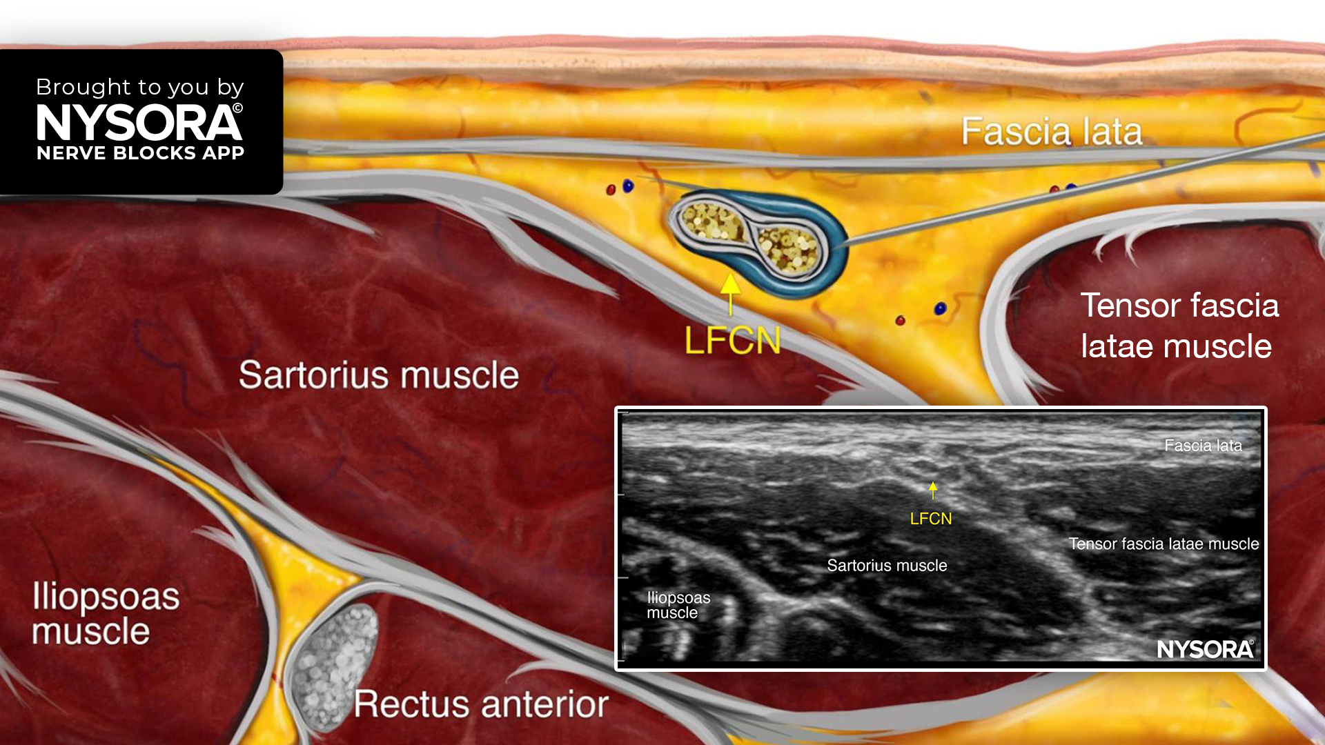 Tips for a Lateral Femoral Cutaneous Nerve Block - NYSORA