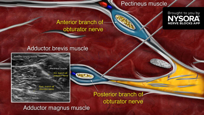 Tips for an Obturator Nerve Block: Distal Approach