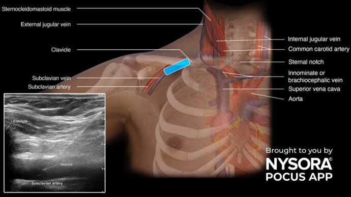 Tips for subclavian vein cannulation