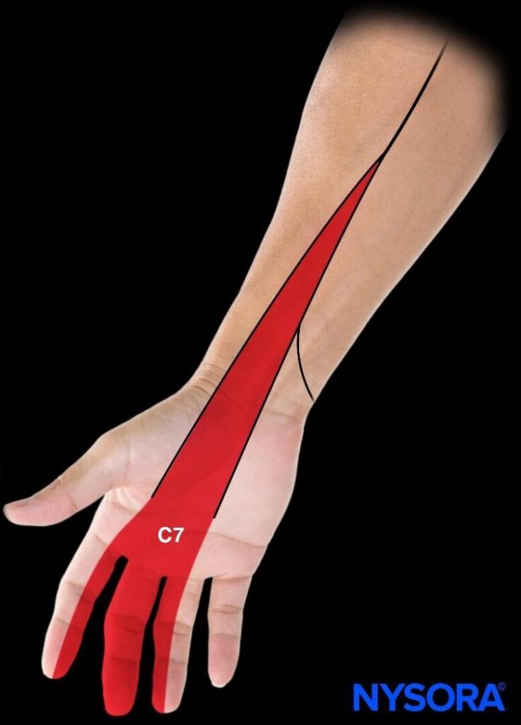 Case study Cervical hernia with radicular pain NYSORA