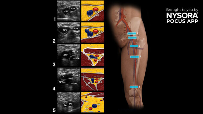 Dealing with acute respiratory failure: How POCUS helps to rule out deep vein thrombosis