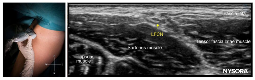 Case study: The utility of a LFCN block in treating meralgia ...