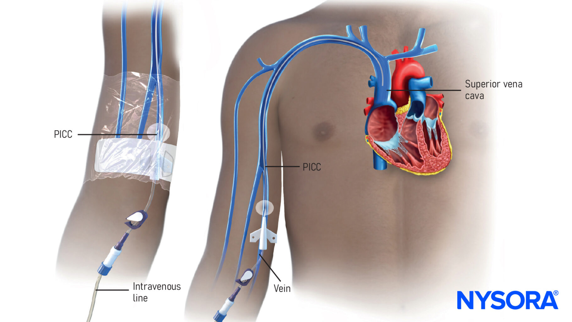Picc Line In Innominate Vein