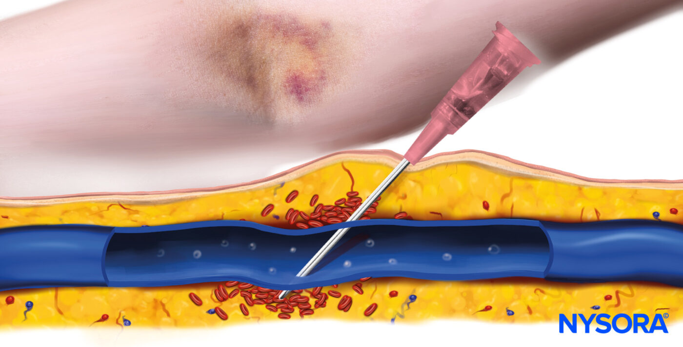 Blown veins Causes, management, and best practices NYSORA