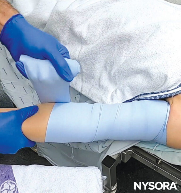 Cannulating complex veins - NYSORA