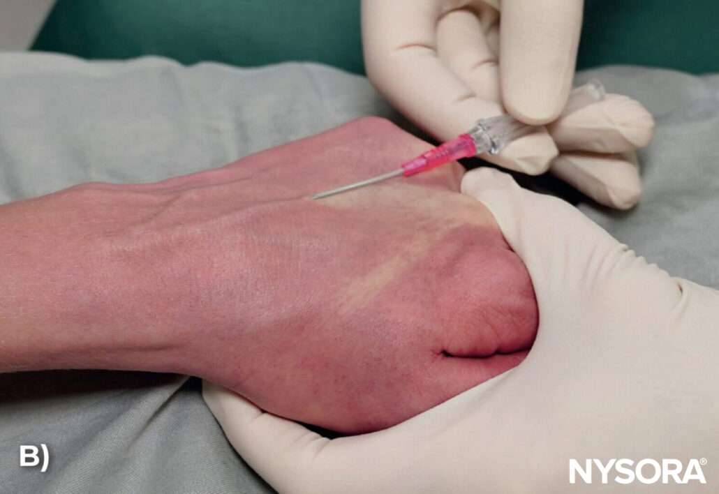 Cannulating complex veins - NYSORA