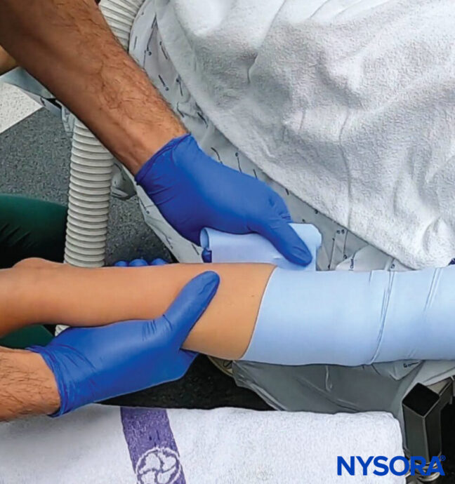 Cannulating complex veins - NYSORA