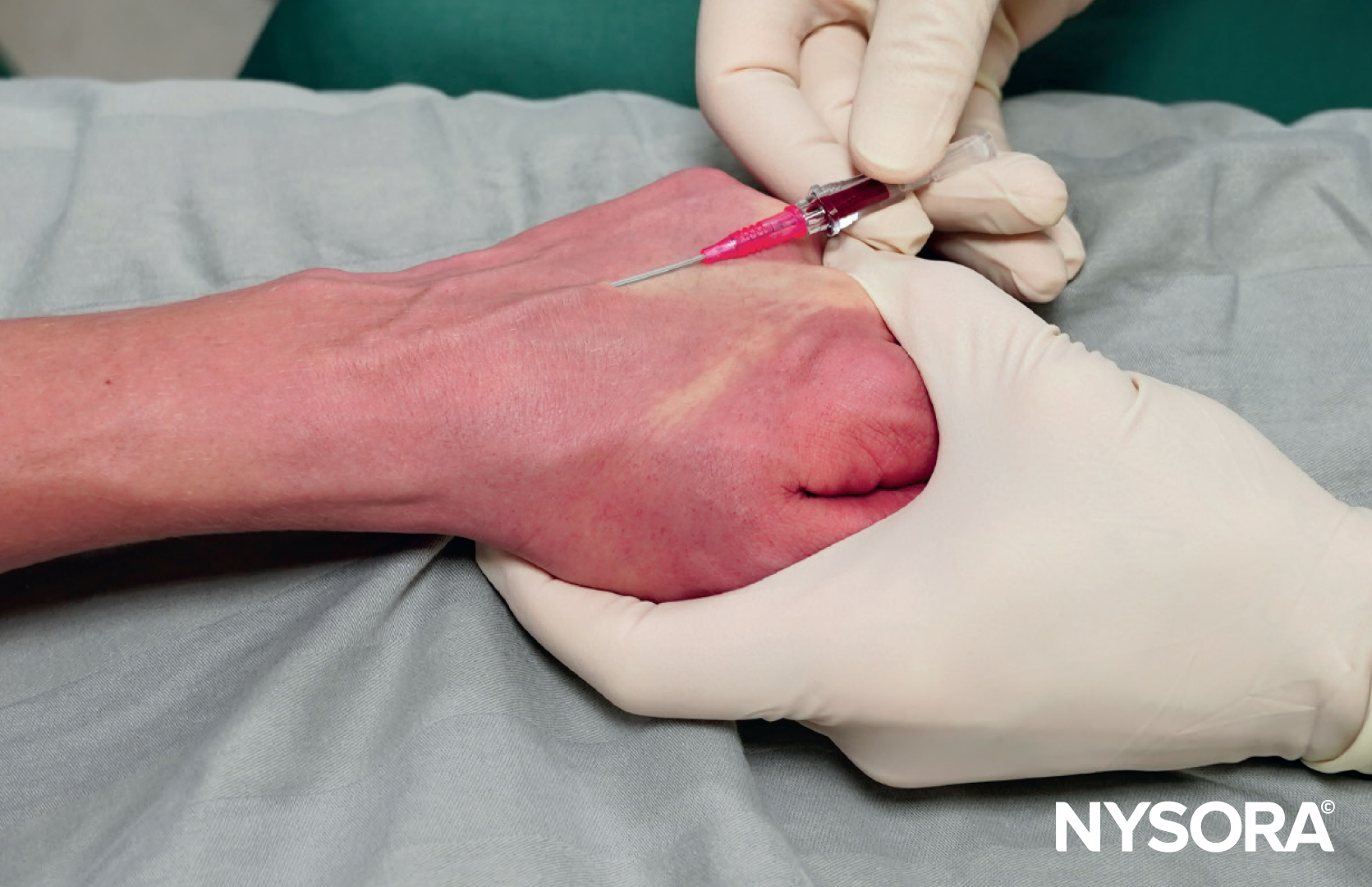 Catheterization technique