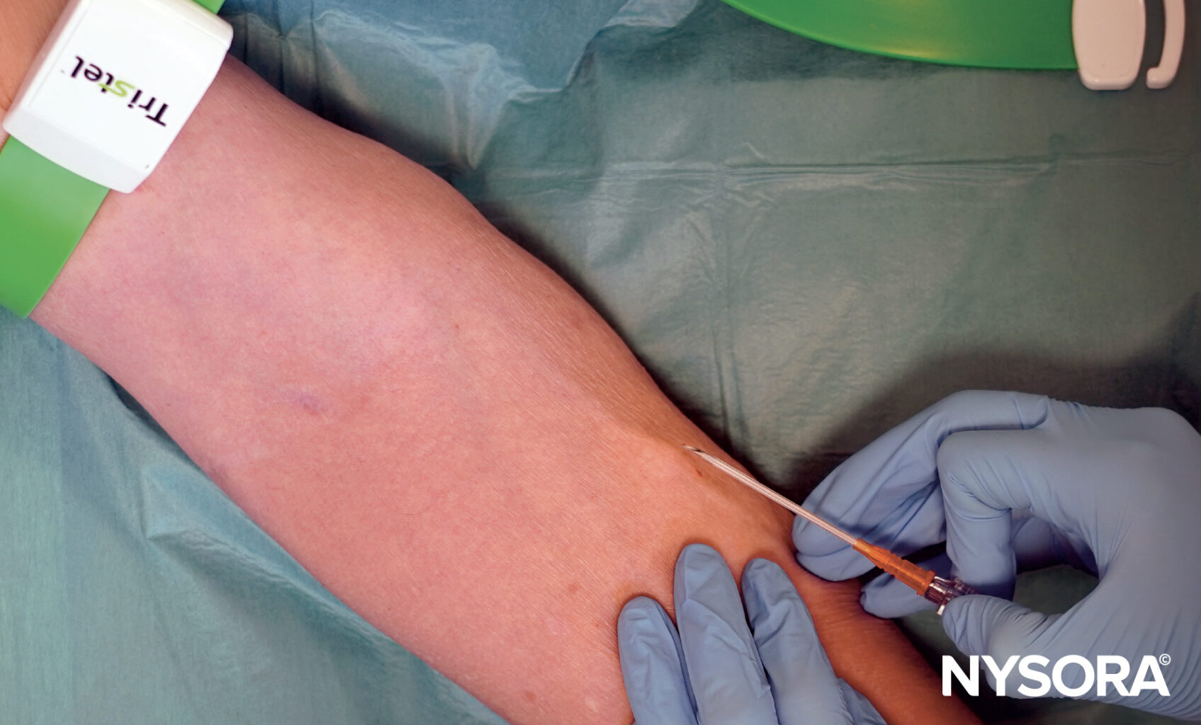 Large IV catheter (14G)