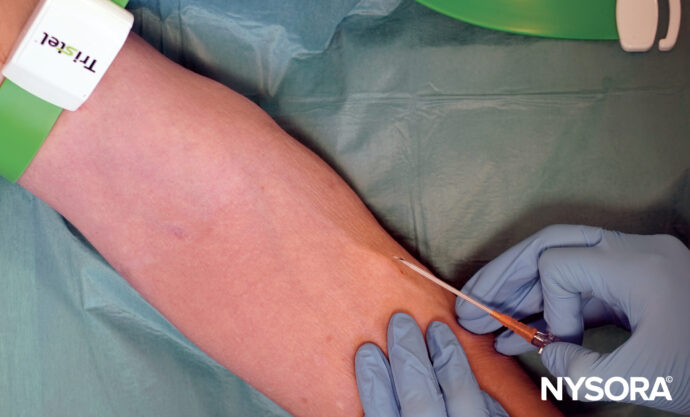 Large vein cannulation - NYSORA