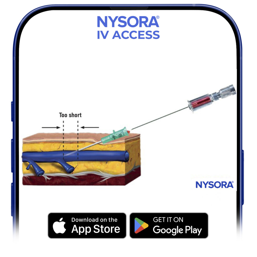 A catheter that is too short 