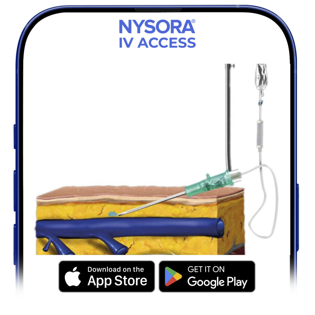 Catheter is dislodged from the vein.