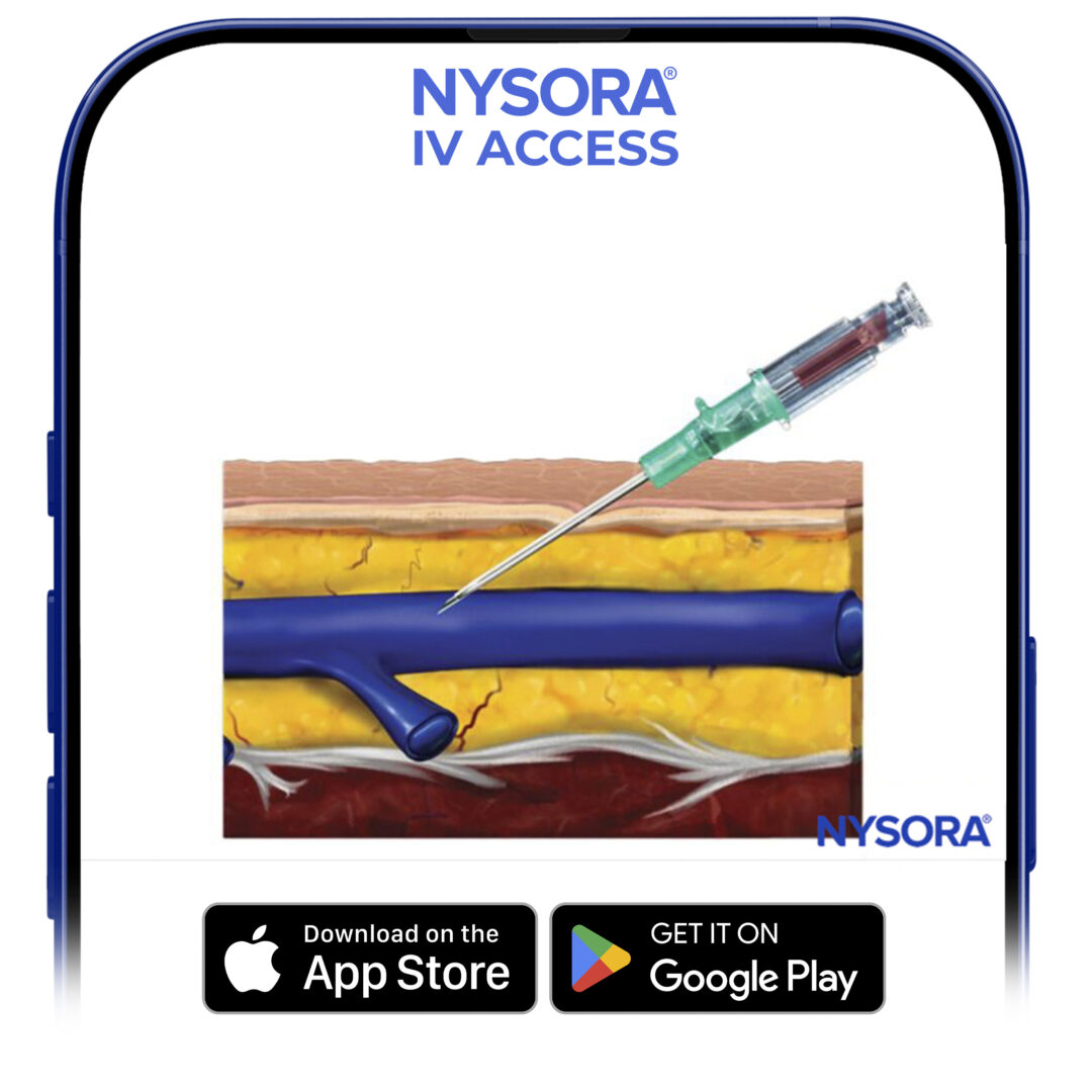 Inadequate depth of the needle-catheter system in the vein