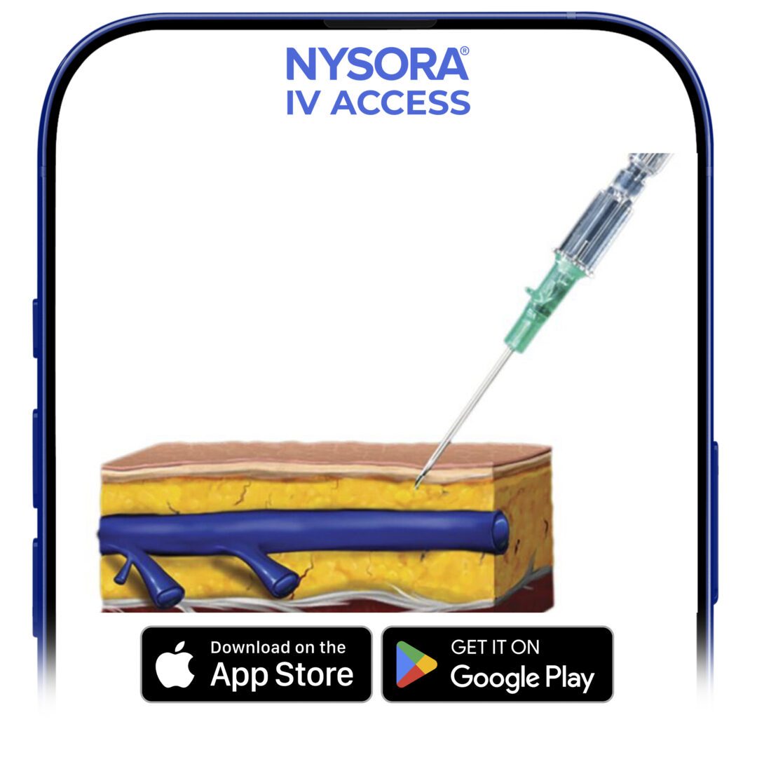 The angle of the needle-catheter insertion is too steep