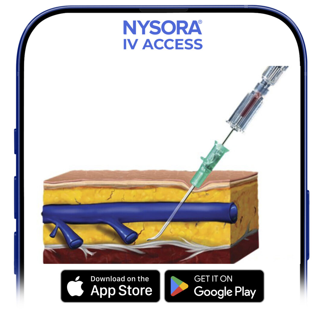 The catheter is placed into the subcutaneous tissue