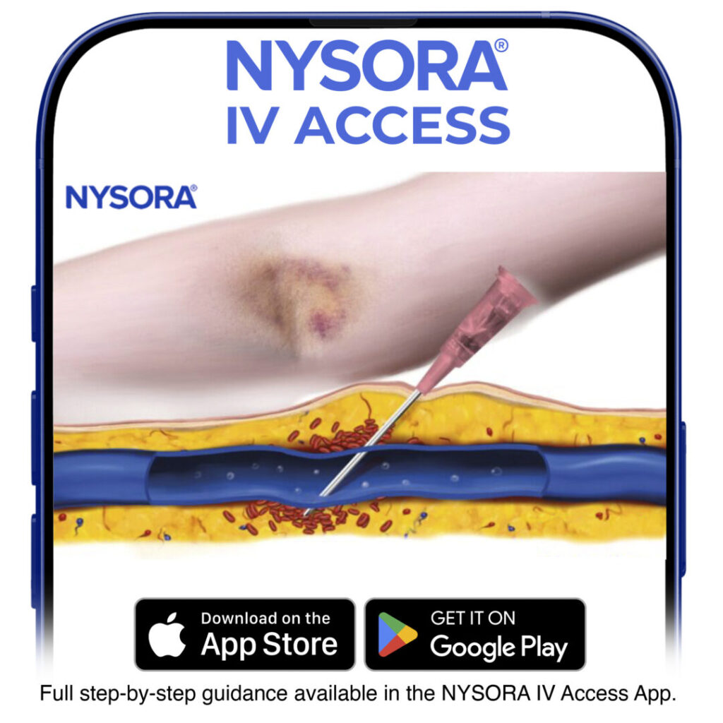 Hematoma after failed cannulation