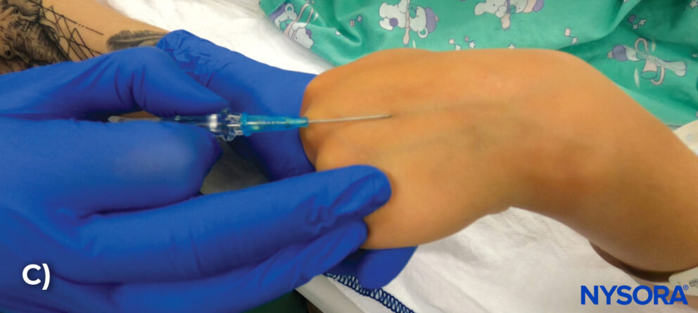 IV access in pediatric patients - NYSORA