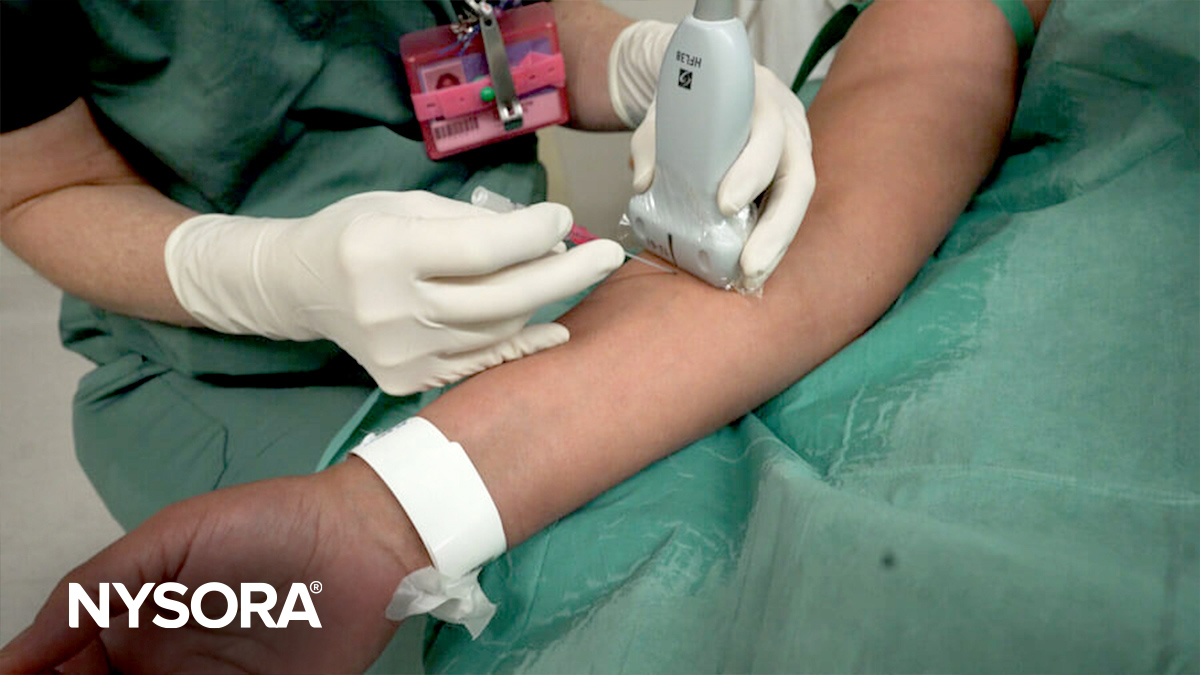 Ultrasound-guided IV access technique