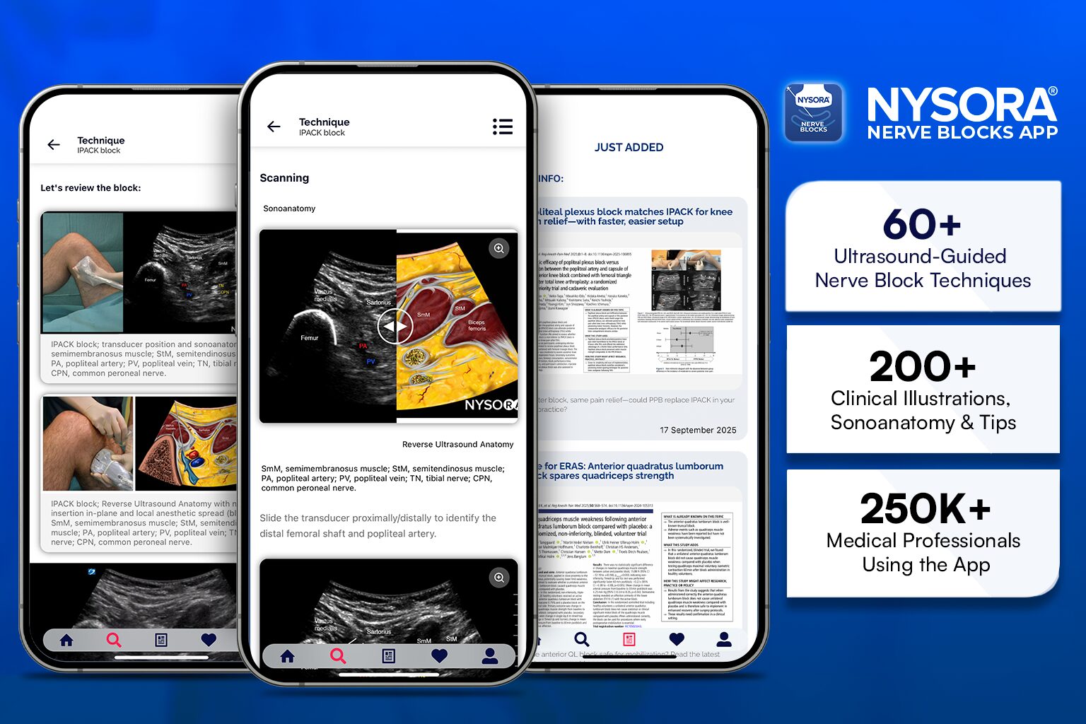 Ultrasound-guided popliteal plexus block at the adductor hiatus for posterior knee analgesia after total knee arthroplasty
