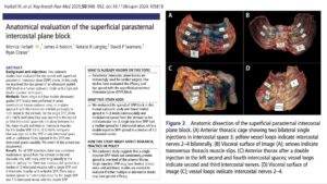 How far does a superficial parasternal block really spread?