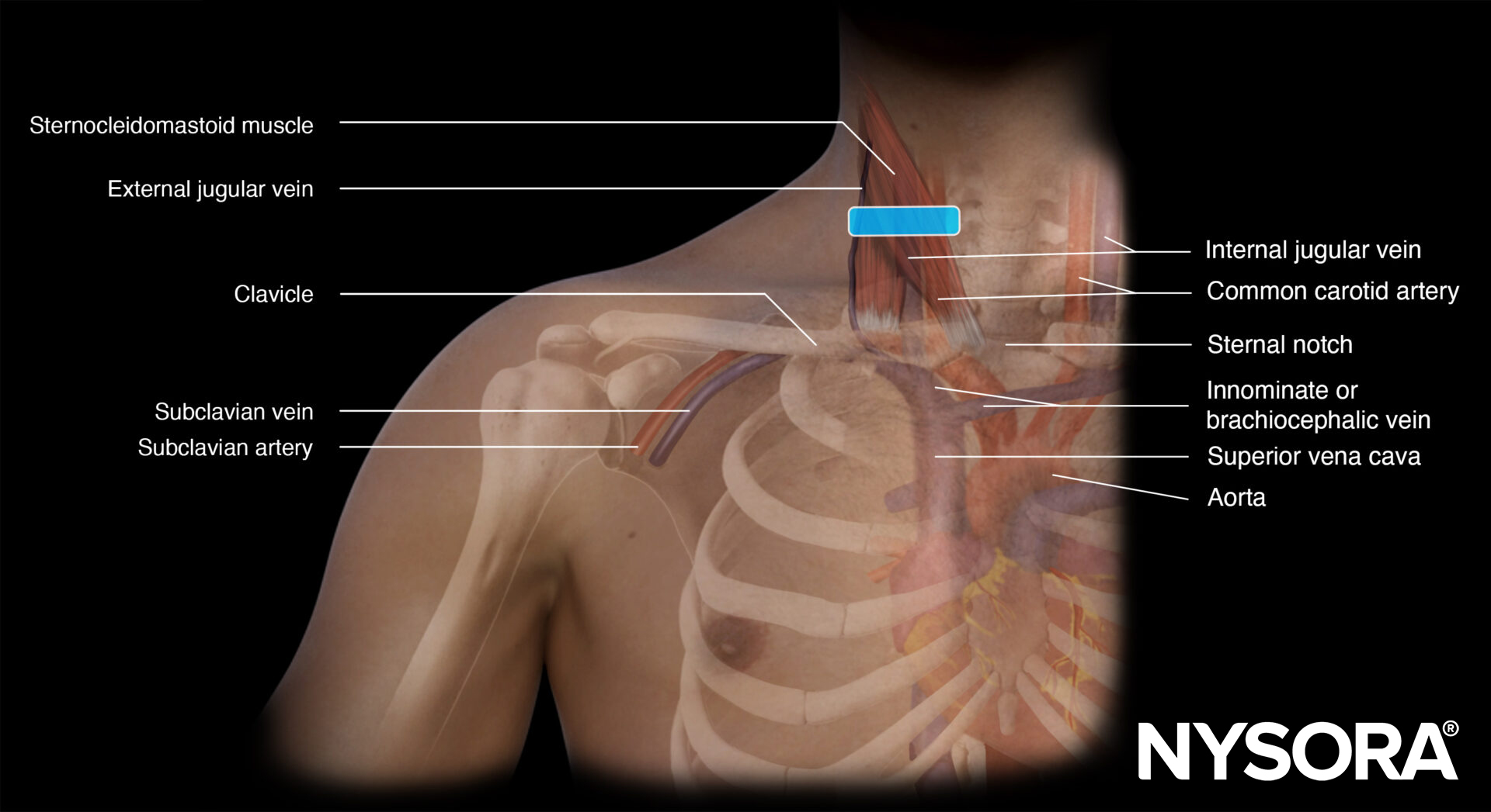 Internal jugular vein cannulation