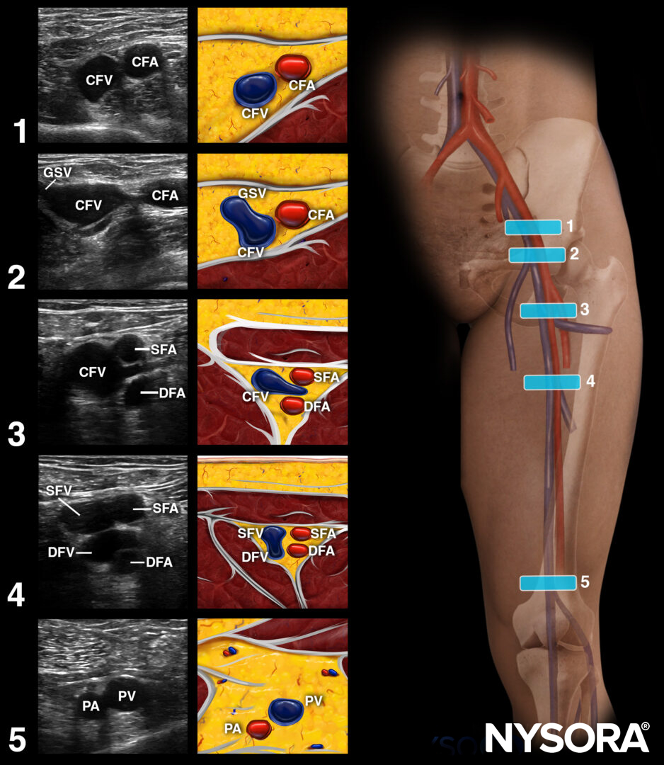 Deep venous thrombosis (DVT)