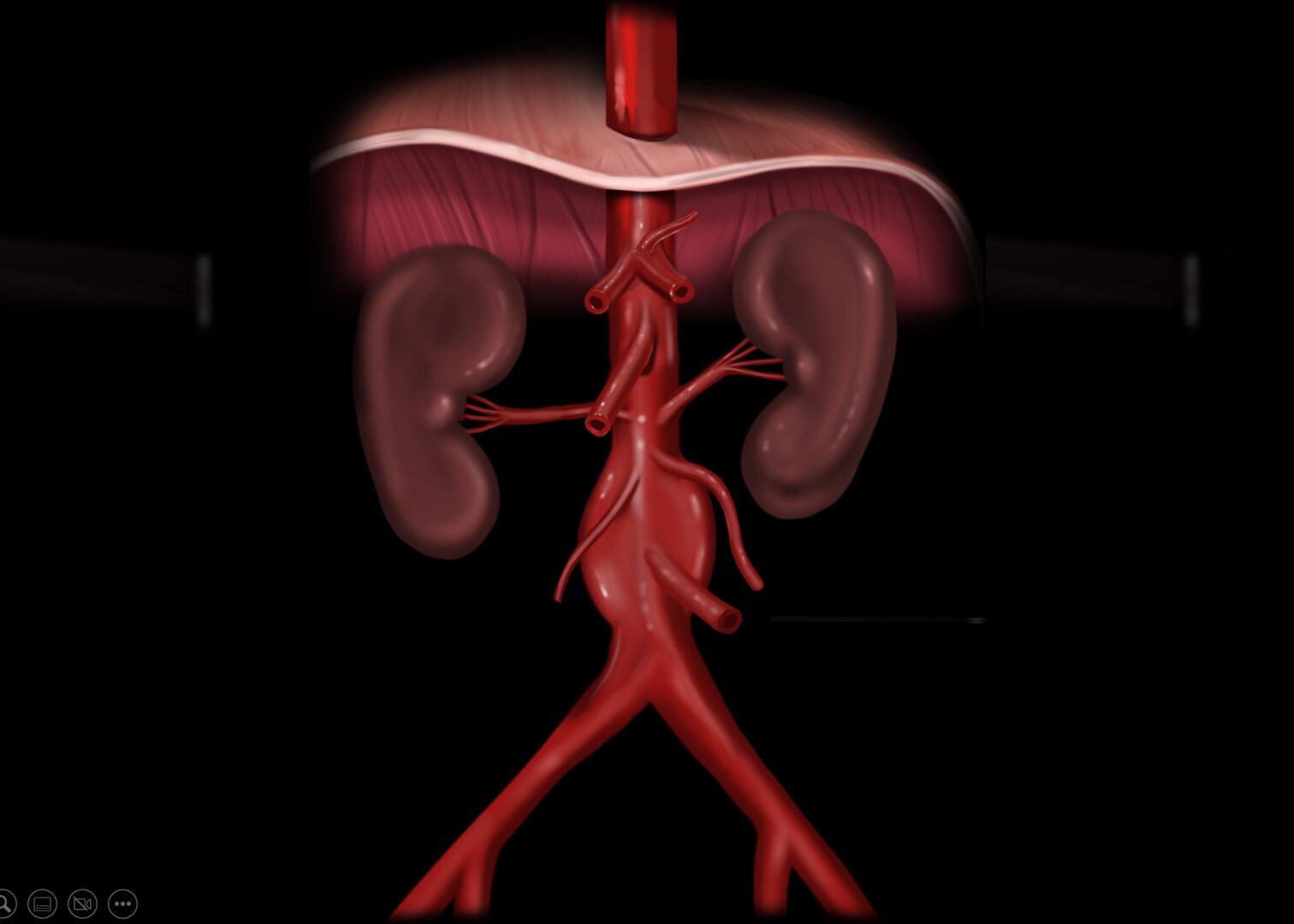Abdominal aortic aneurysm (AAA)