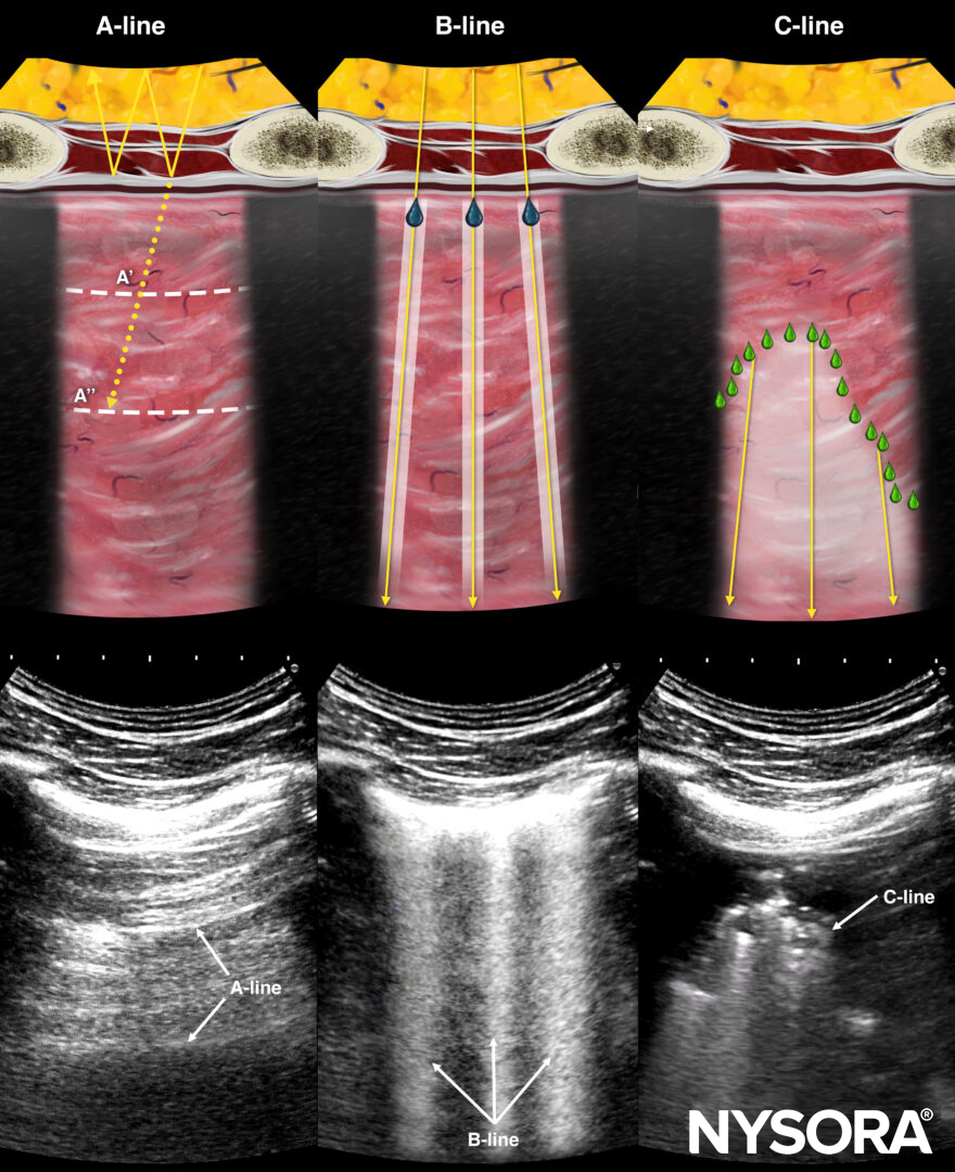 Acute respiratory failure: The BLUE protocol