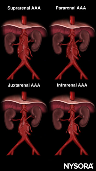 Abdominal aortic aneurysm (AAA) - NYSORA