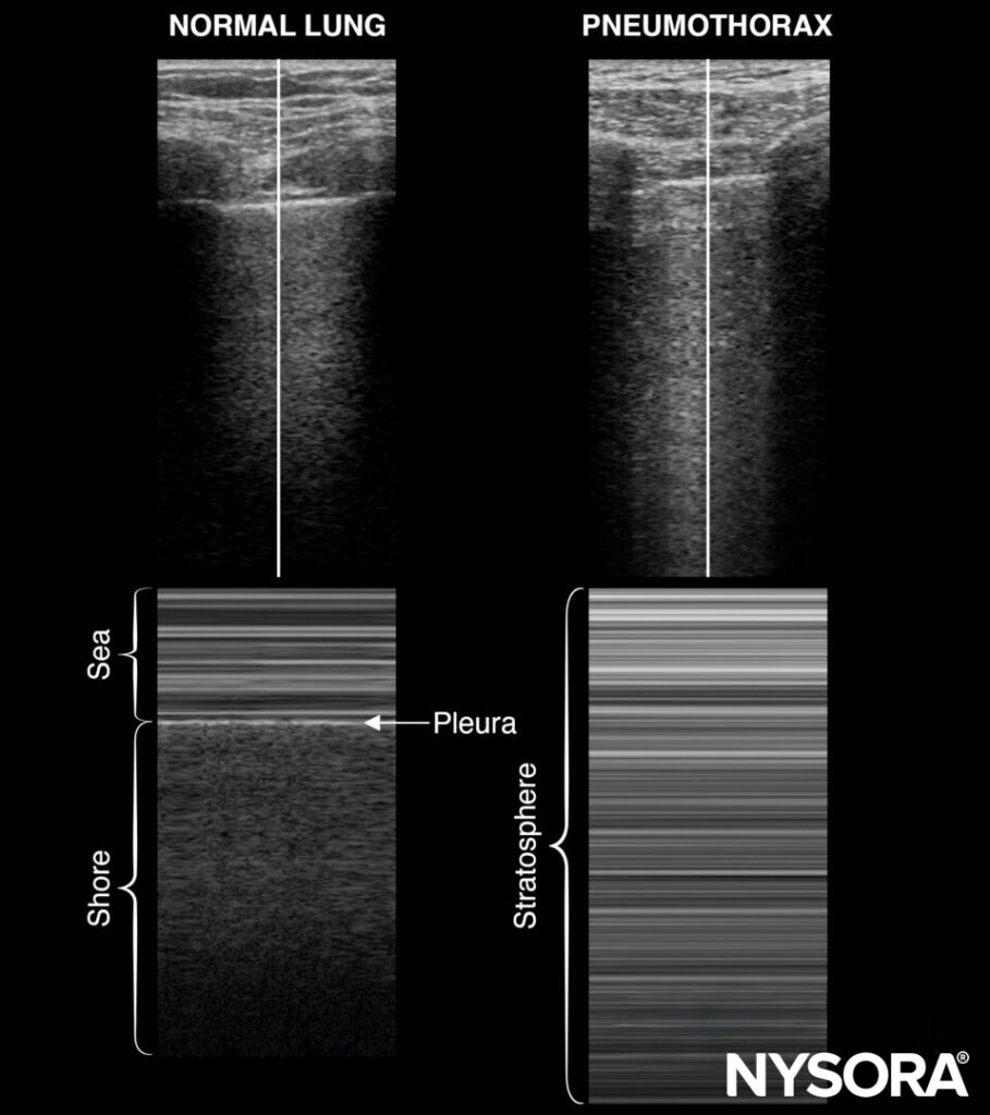 Internal jugular vein cannulation - NYSORA
