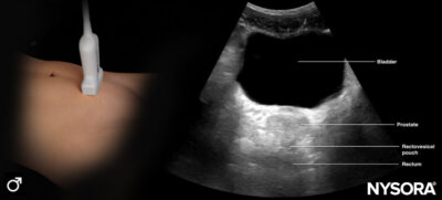 Bladder ultrasound - NYSORA