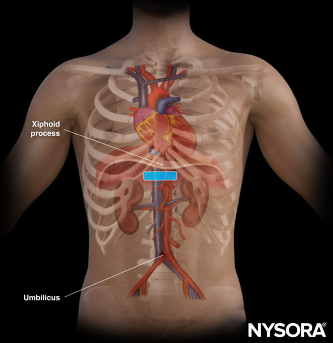 Proximal Aaa Abdominal aortic aneurysm (AAA) - NYSORA