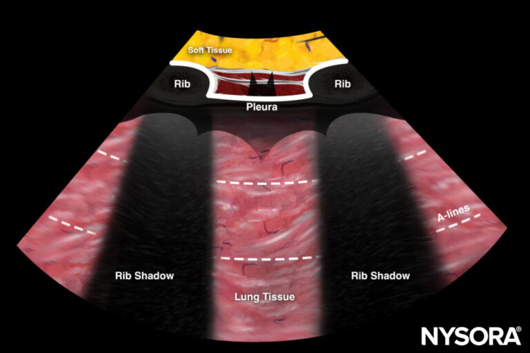 Two Adject Ribs Essential lung ultrasound - NYSORA