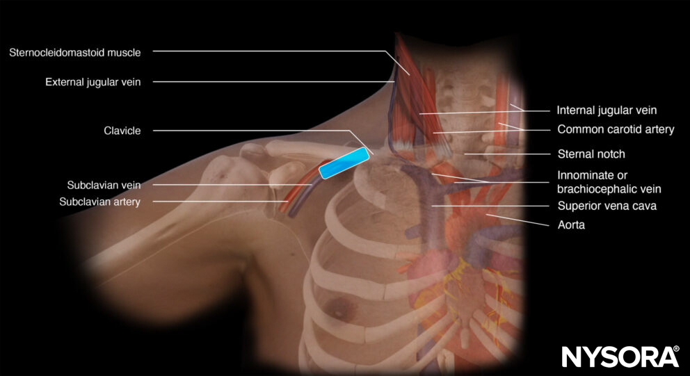 Subclavian vein cannulation