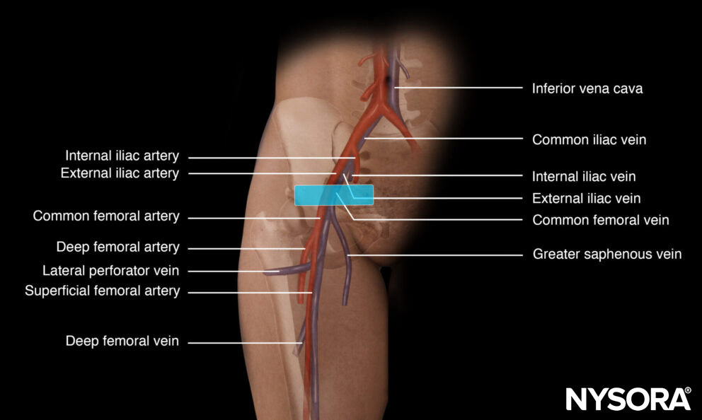 Femoral artery cannulation