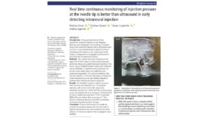 Needle-tip pressure monitoring detects intraneural injection earlier than ultrasound